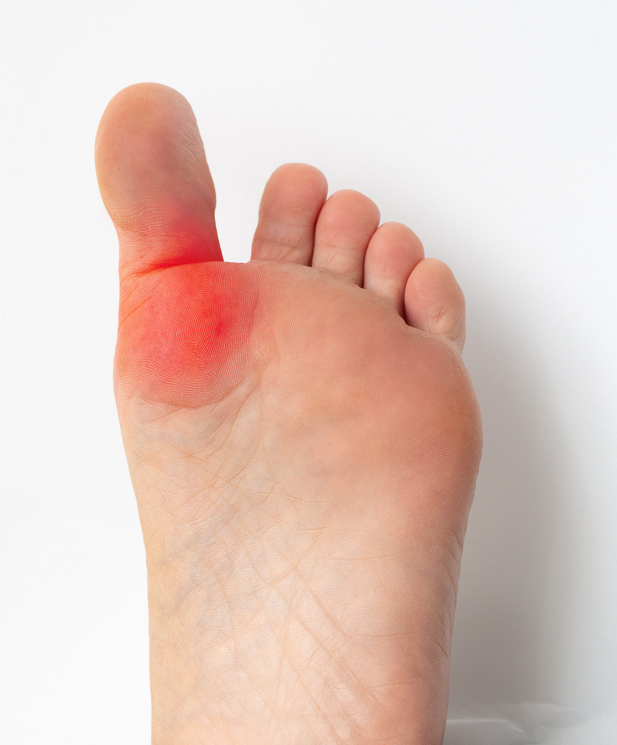 Swollen big toe with redness on foot
