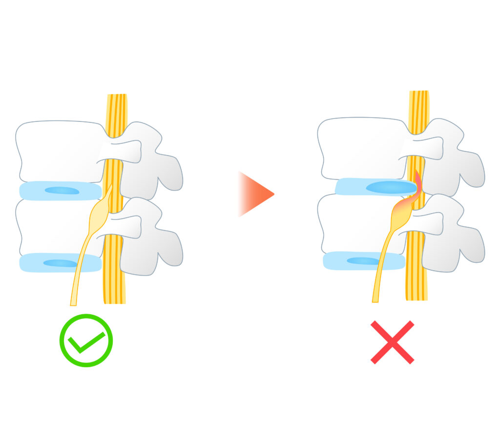 Healthy vs herniated spinal disc comparison