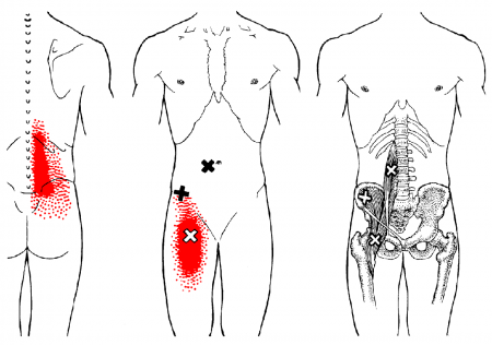 Lower back and hip pain illustration with highlights.