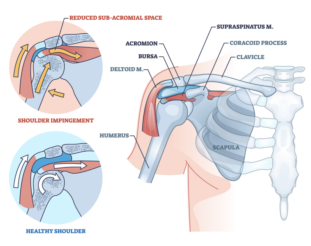 Illustration of shoulder anatomy and impingement condition.
