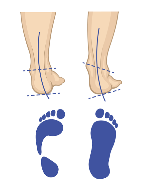Foot arch comparison diagram with footprints.